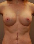 Results of breast augmentation treatment in Minneapolis with Dr. George Landis