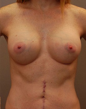 Results of breast augmentation treatment in Minneapolis with Dr. George Landis