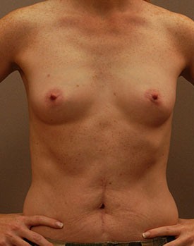 Front view of patient before their breast augmentation procedure