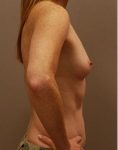 Before plastic surgery with breast implants to increase volume