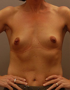 Front view of plastic surgery patient before placement of breast implants