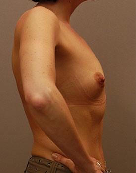 Before augmentation of petite breasts with implants in Minneapolis