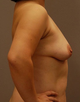 Before breast augmentation surgery in Minneapolis with Dr. George Landis