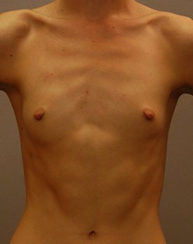 Naturally thin patient before breast augmentation in Minneapolis