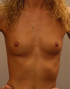 Patient before getting breast implants in Minneapolis with Dr. Landis