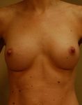 After breast augmentation surgery in Minneapolis with natural-looking implants