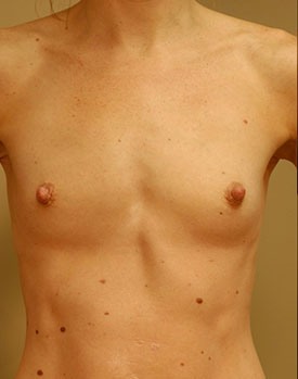 Patient pictured before breast augmentation surgery with Dr. Landis