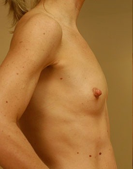 Patient poses in profile before their breast implant surgery
