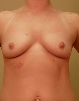 Font-on image of patient before breast implants in Minneapolis