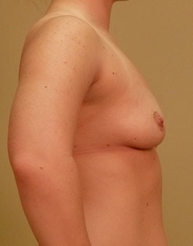 Patient in profile before breast augmentation surgery