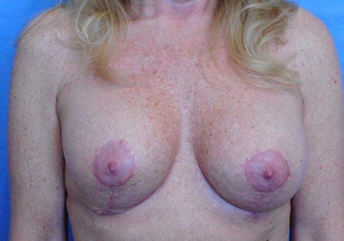 after breast lift front view case 1098