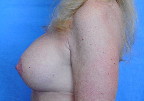 after breast lift side view case 1098