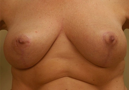after breast lift front view case 1103