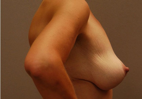 after breast lift side view case 1108