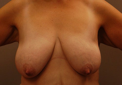before breast lift front view case 1108