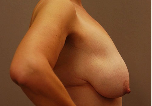 before breast lift side view case 1108