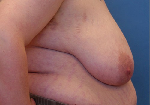 before breast reduction side view case 1116