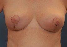 after breast reduction front view case 2