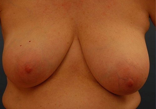 before breast reduction front view case 2