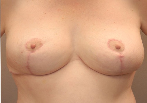 after breast reduction front view case 1126