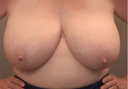 before breast reduction front view case 1126
