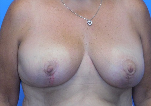 after breast reduction front view case 1141