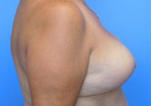 after breast reduction side view case 1141