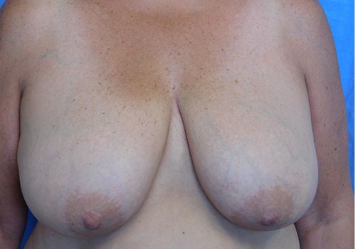 before breast reduction front view case 1141