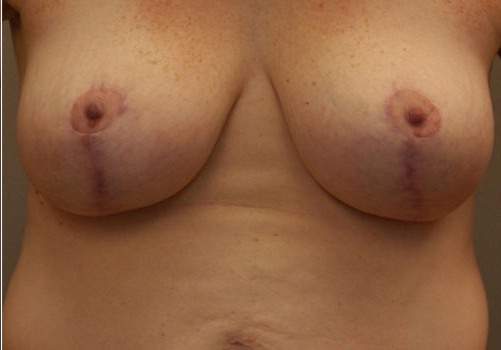 after breast reduction front view case 8