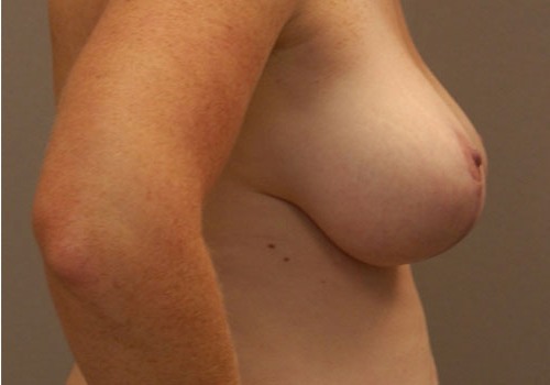 after breast reduction side view case 8