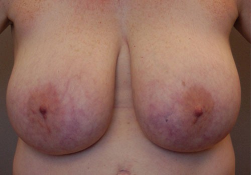 before breast reduction front view case 8