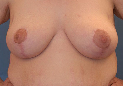 after breast reduction front view case 1116