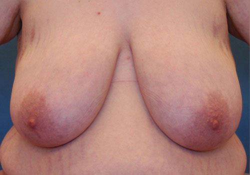 before breast reduction front view case 1116