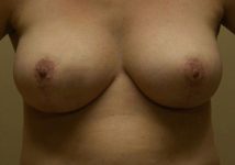 after breast reduction front view case 5
