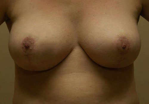 after breast reduction front view case 5