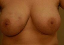 before breast reduction front view case 5