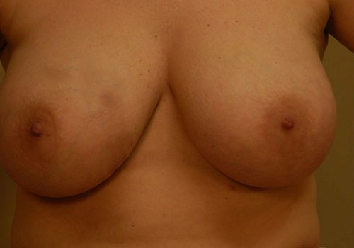 before breast reduction front view case 5