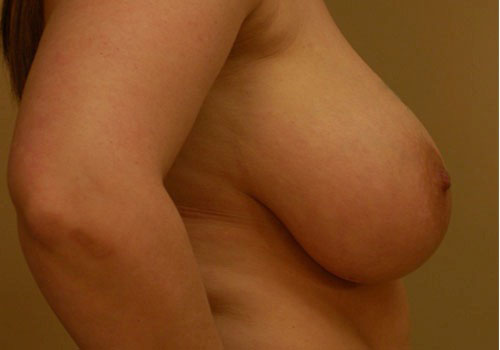 before breast reduction side view case 5