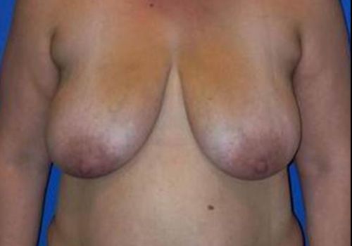 before breast lift front view case 1979