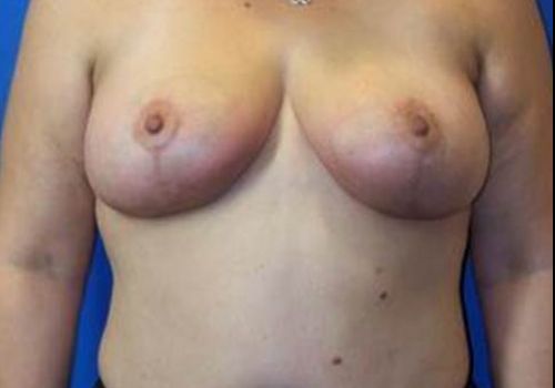 after breast lift front view case 1979