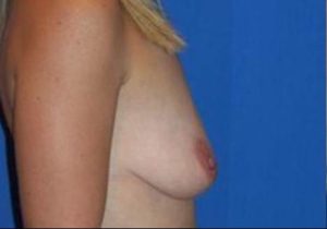 before breast lift side view case 1987
