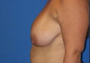 before breast lift side view case 1992