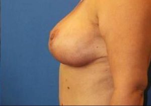 breast lift side view case 1992