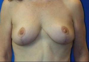 after breast lift front view case 1995