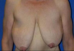 before breast lift front view case 1995