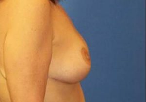 after breast lift side view case 1998