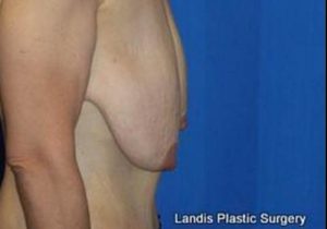 before breast lift side view case 1998