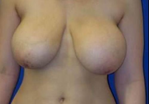 before breast reduction front view case 2033