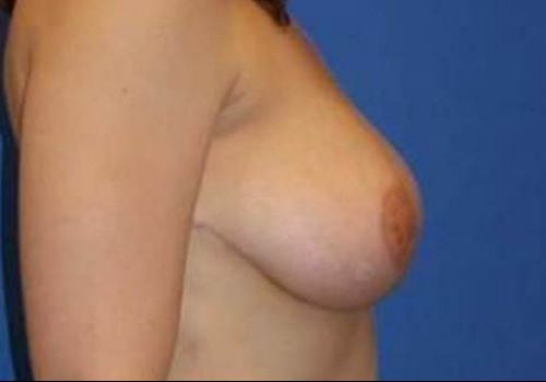 after breast reduction side view case 2036