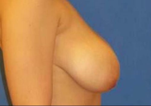 before breast reduction side view case 2036